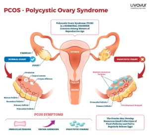 Ayurvedic Treatment and Remedies to Polycystic Syndrome PCOS 1 11zon