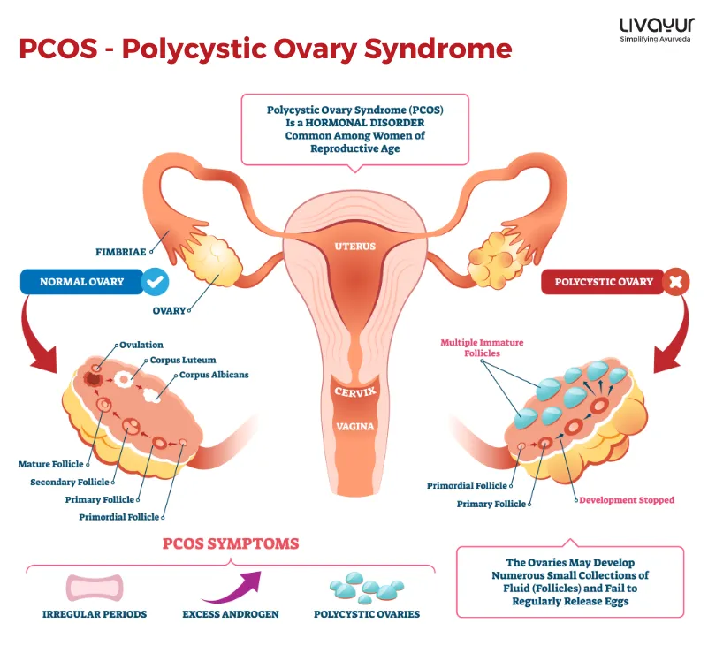 Ayurvedic Treatment and Remedies to Polycystic Syndrome PCOS 1 11zon