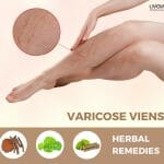 varicose veins treatment