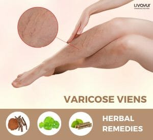 varicose veins treatment