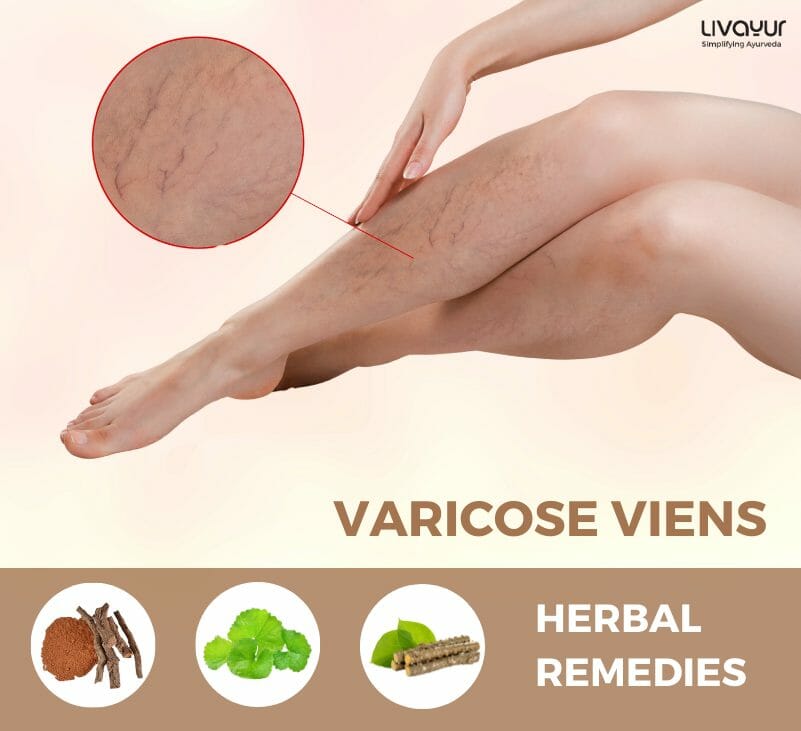 varicose veins treatment