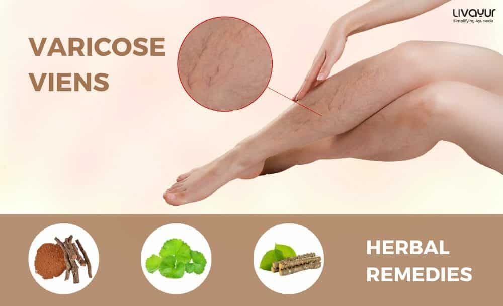 varicose veins treatment