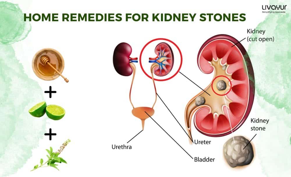 Ayurveda to Get Rid of Kidney Stones Painlessly 2