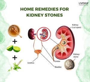 Ayurveda to Get Rid of Kidney Stones Painlessly 3