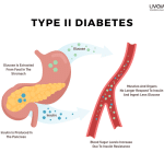 Type 2 Diabetes