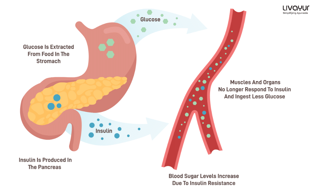 Type 2 Diabetes What is it Symptoms Causes Risk Factors Treatment