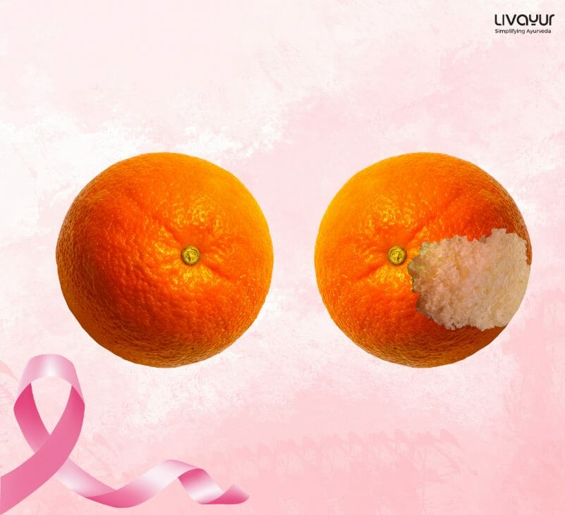 Breast Cancer