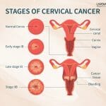 Cervical Cancer 1