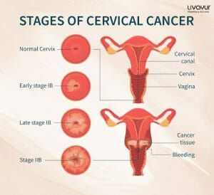 Cervical Cancer 1
