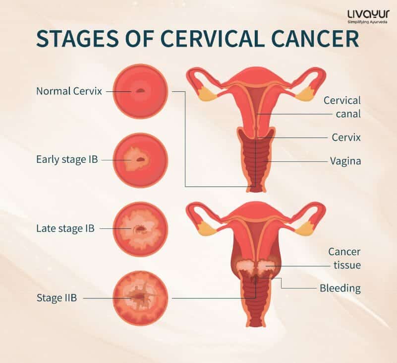 Cervical Cancer 1