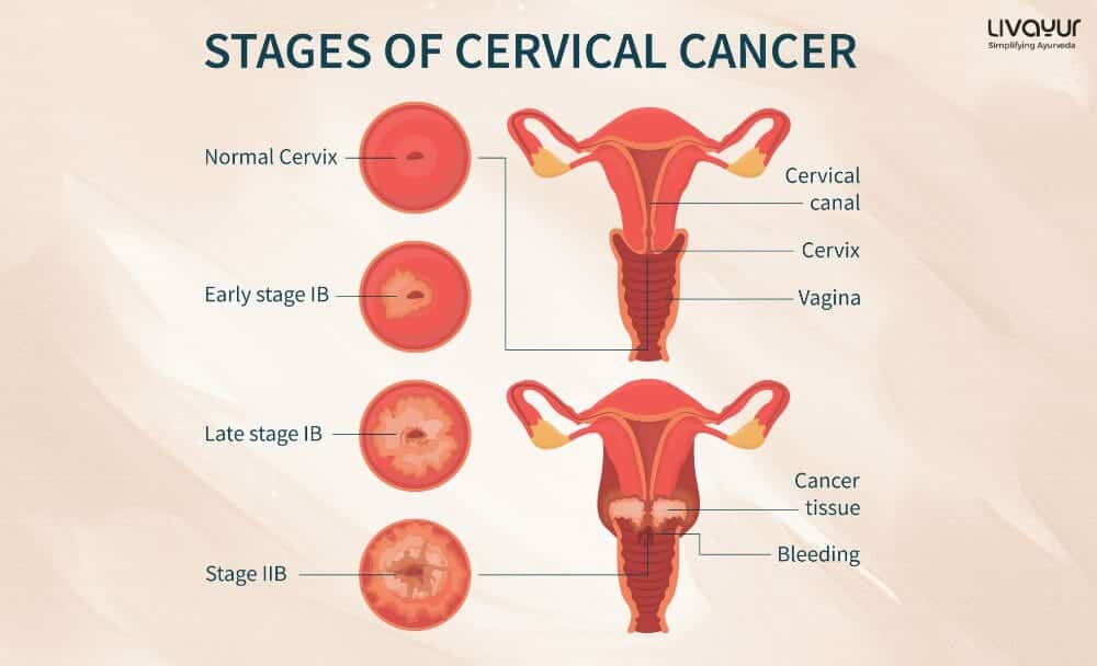 Cervical Cancer