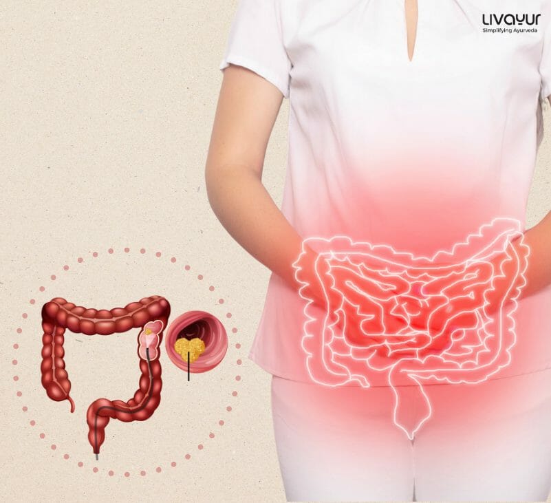 Colorectal Cancer 1