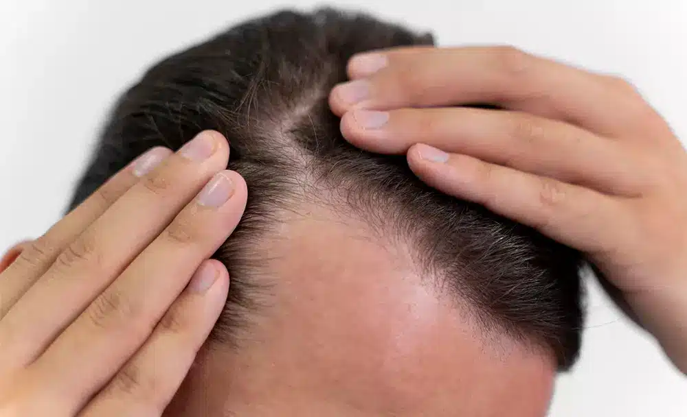 Causes and Risk Factors for Androgenetic Alopecia  Everyday Health