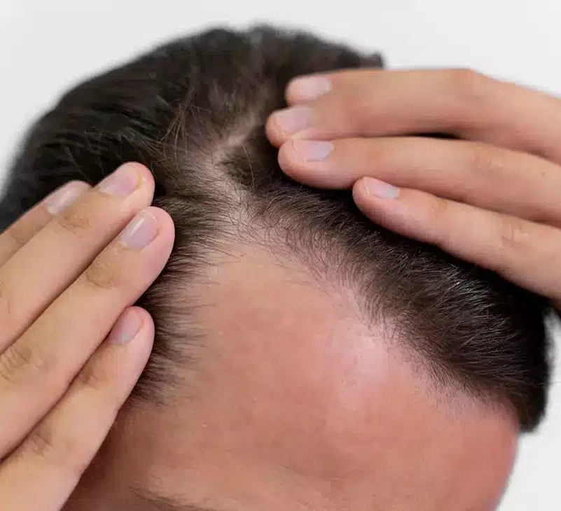 hair loss treatment - livayur