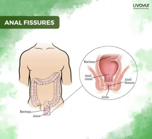 Anal Fissure Symptoms Causes Treatment Prevention 1