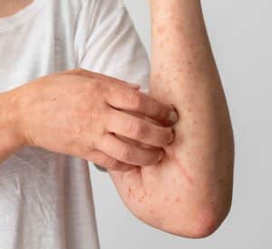 skin rash - livayur