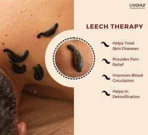 Leech Therapy What it is Benefits Side Effects How its Done 2