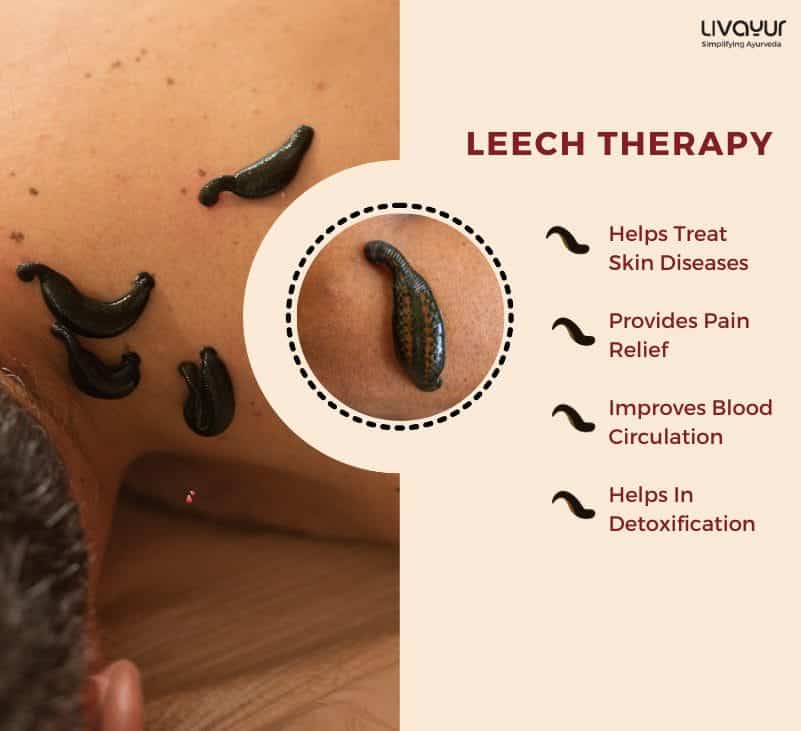 Leech Therapy What it is Benefits Side Effects How its Done 2
