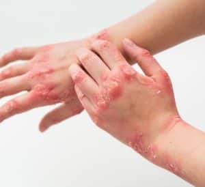 measles causes