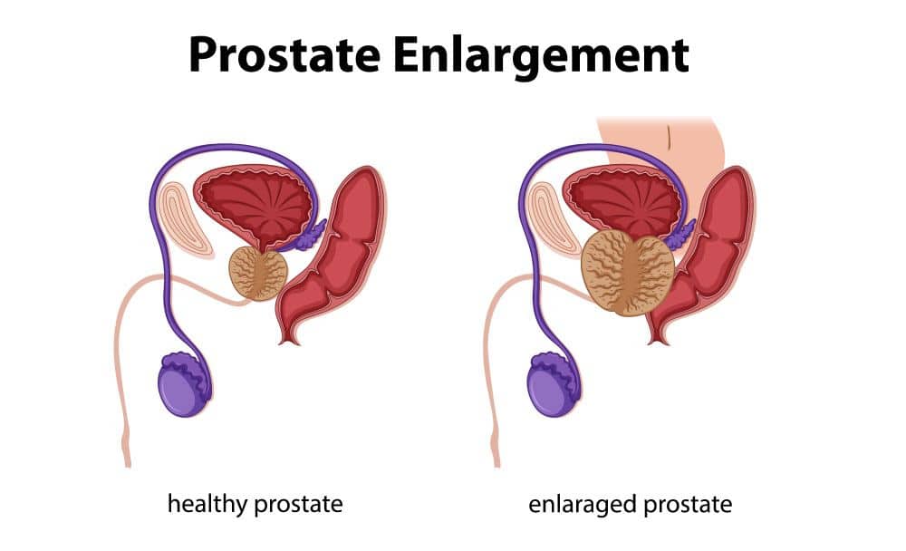 what is prostatomegaly - livayur