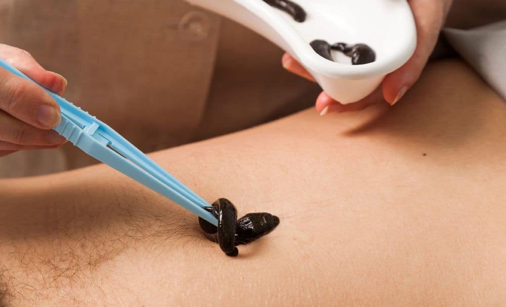  leech therapy - livayur