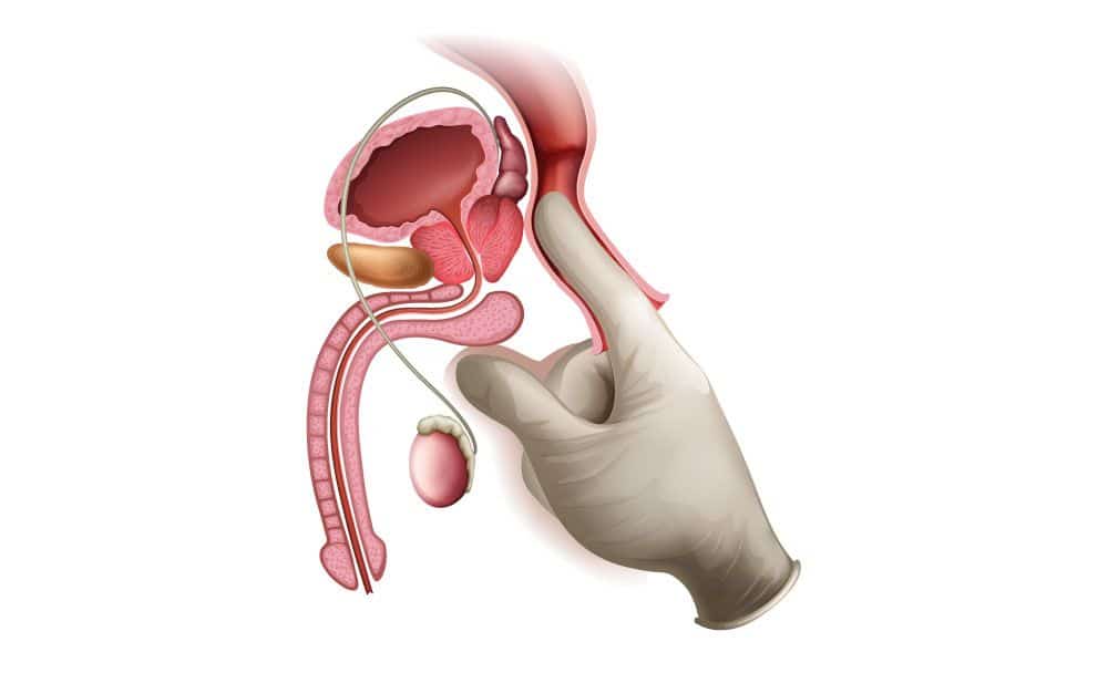 prostatomegaly diagnosis