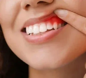 gingivitis - livayur