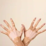 vitiligo - livayur