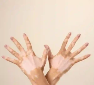 vitiligo - livayur