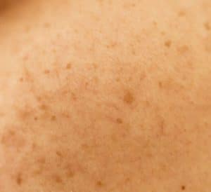 melasma - livayur