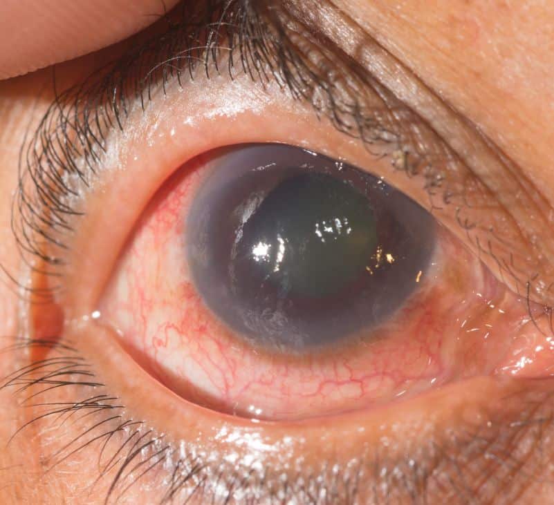 glaucoma - livayur
