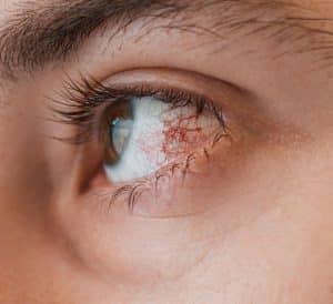 conjunctivitis - livayur