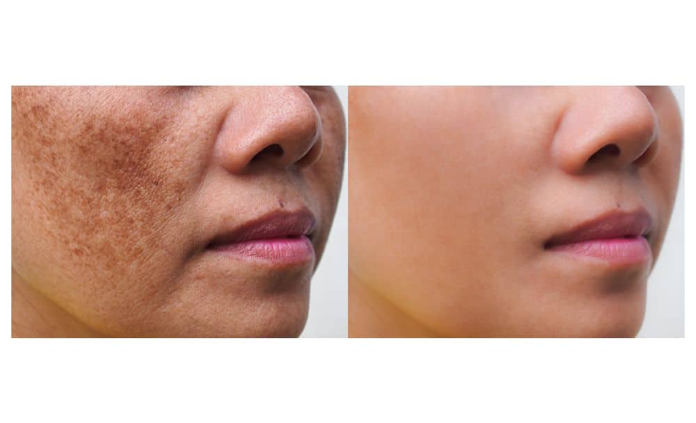 melasma treatment