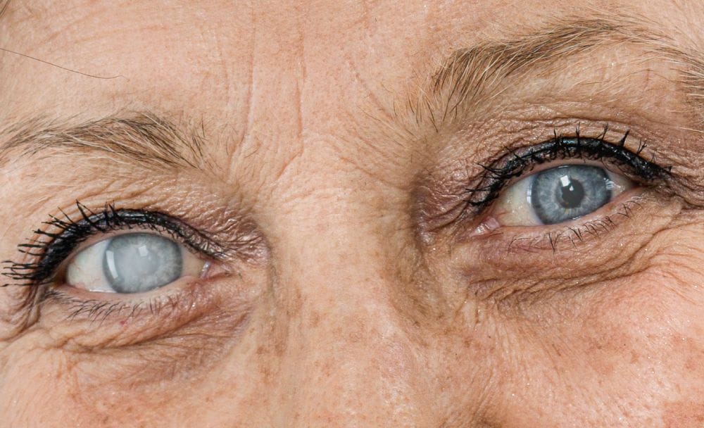 glaucoma symptoms