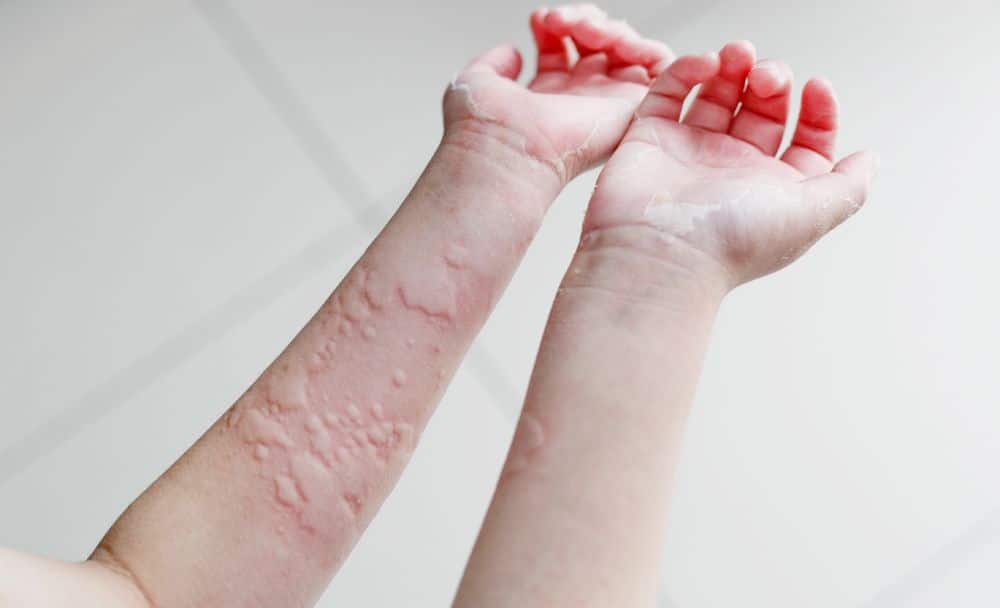 urticaria causes - livayur