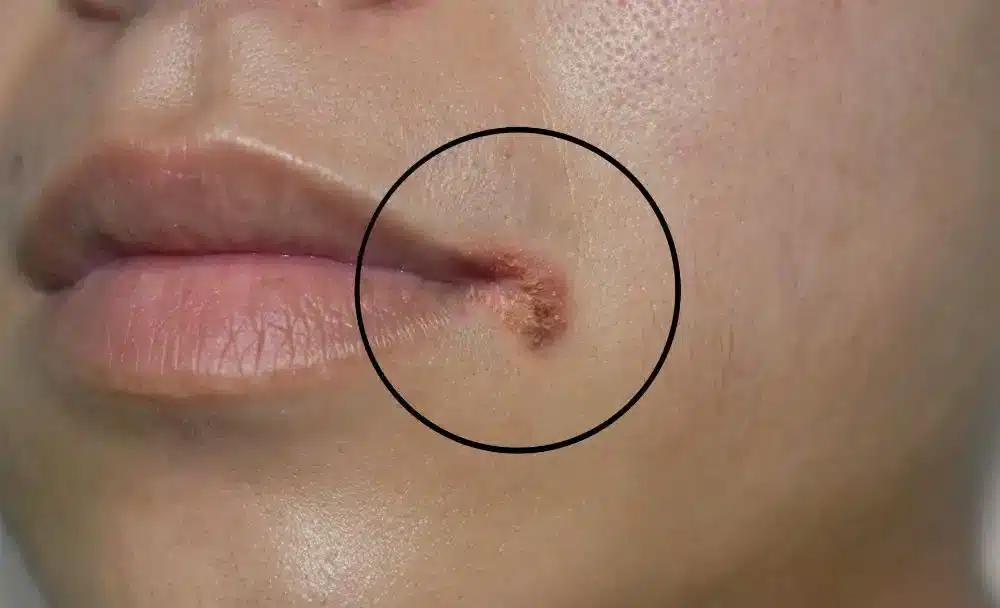 cheilitis - livayur