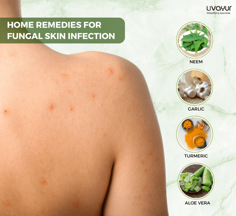 fungal skin infection - livayur