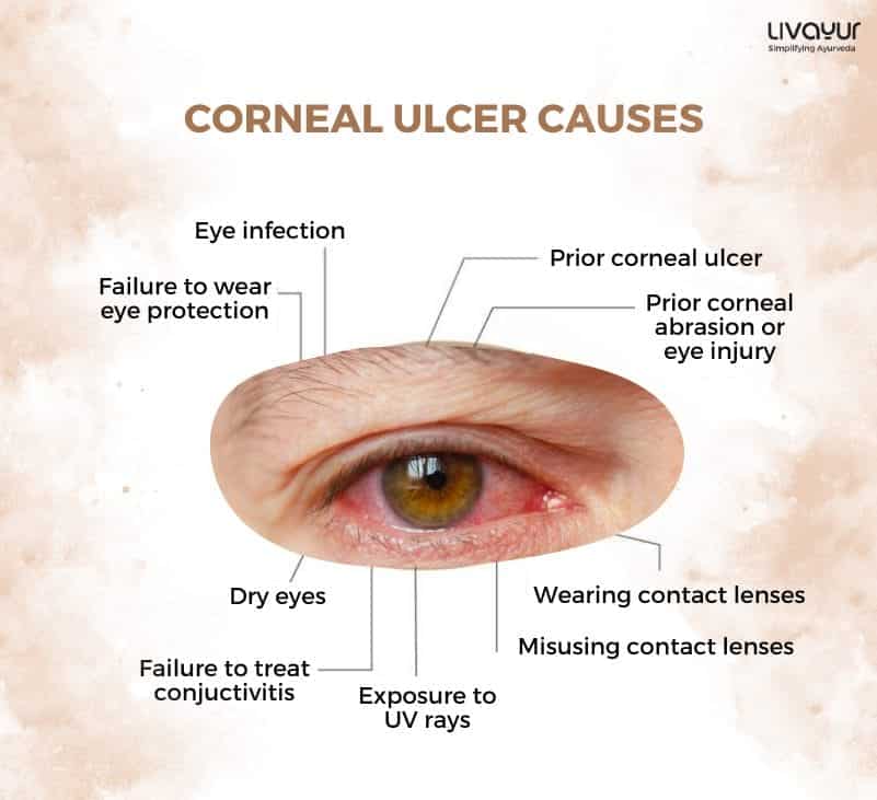 Corneal Ulcer What Is It Causes Symptoms Treatment 2