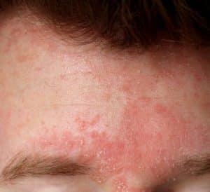 Seborrheic Dermatitis