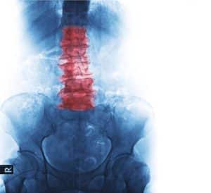 ankylosing spondylitis - livayur