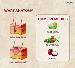 How to Remove Warts