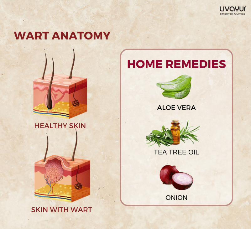 How to Remove Warts