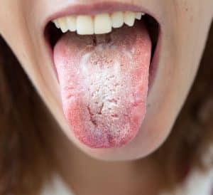 tongue infection - livayur