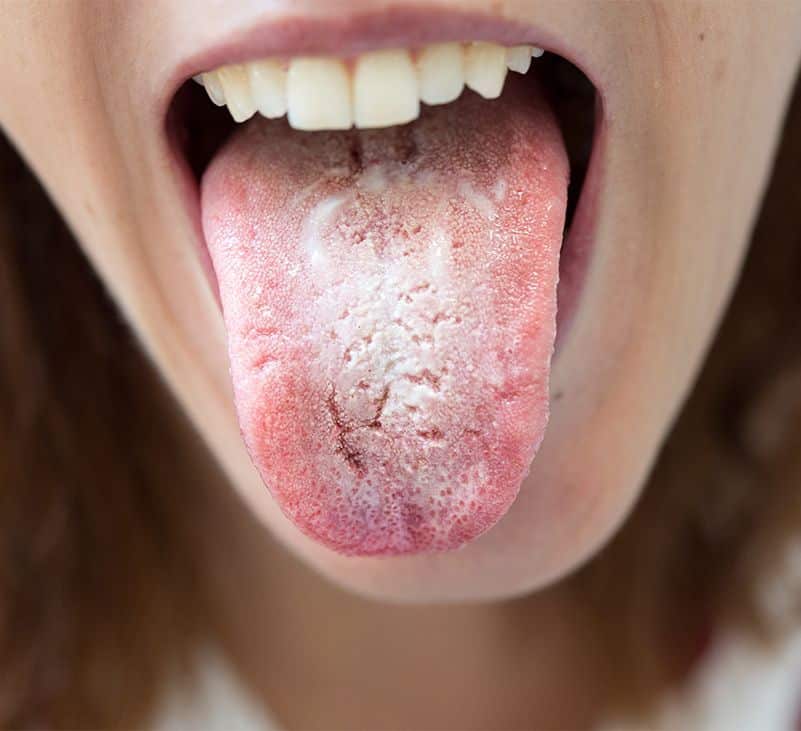 tongue infection - livayur
