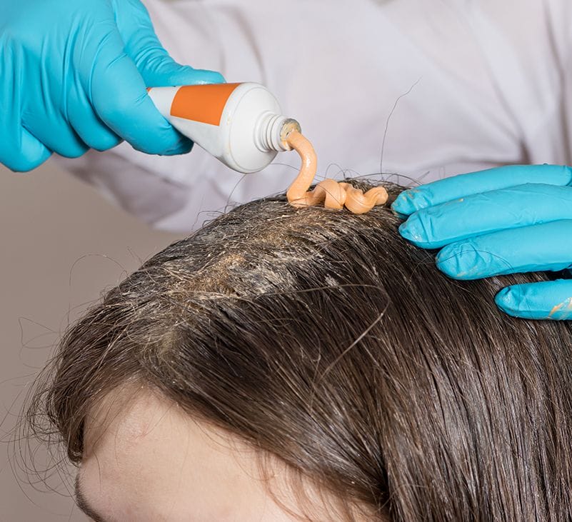 scalp psoriasis - livayur