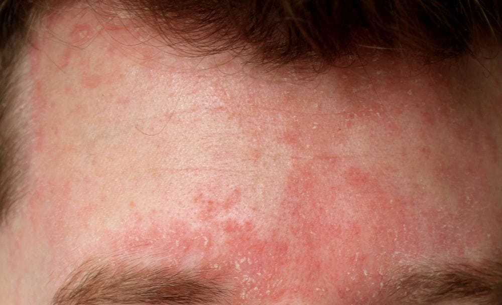 Seborrheic Dermatitis