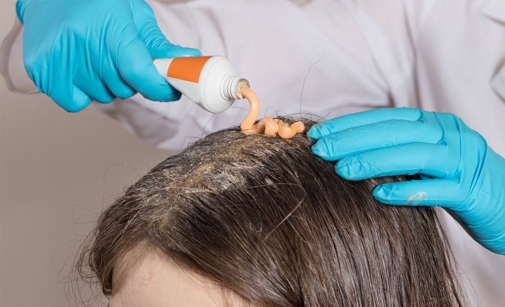 scalp psoriasis - livayur