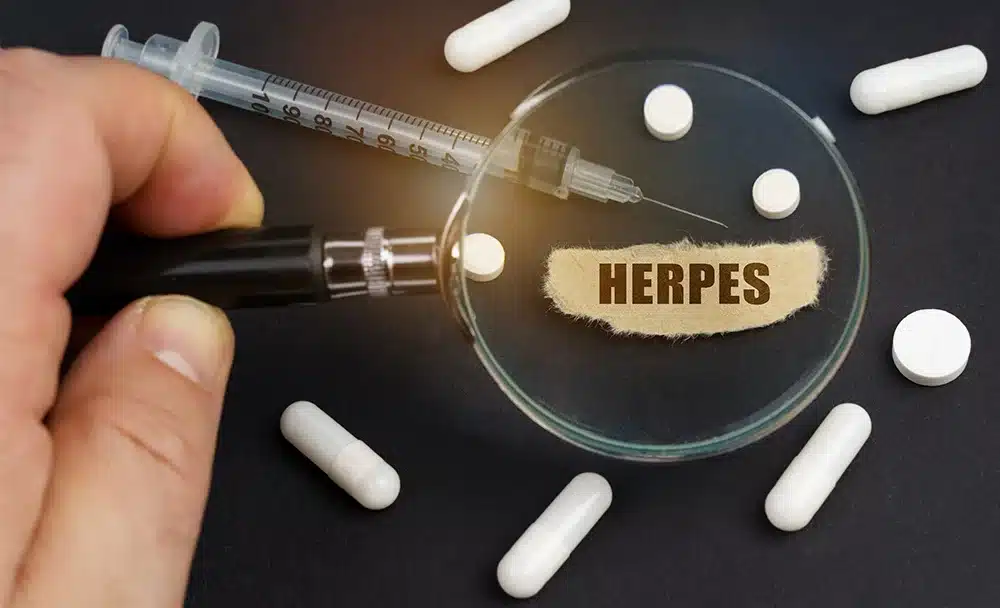 Herpes Symptoms