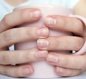 White Spots on Nails