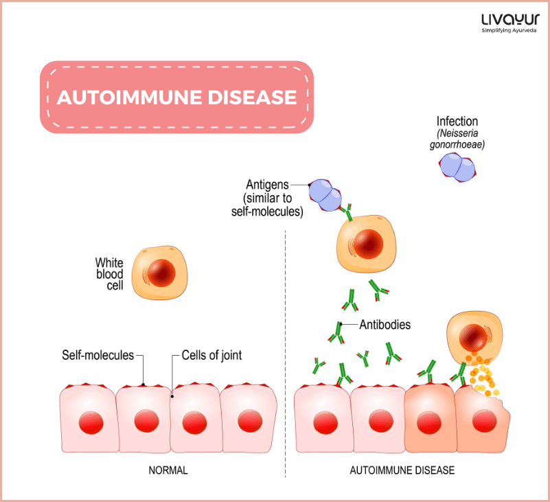 Autoimmune Disease Causes Symptoms Types Treatment More 1